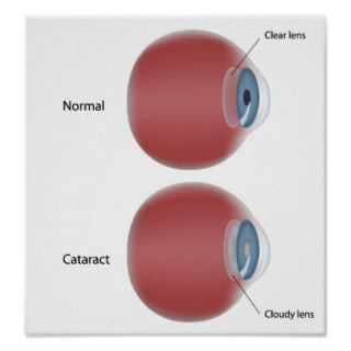 Eye disease cataract   Poster