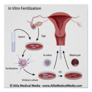 In Vitro Fertilization (IVF) procedure labeled. Poster