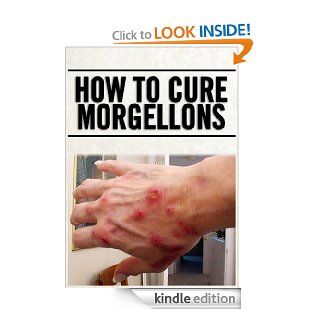 How To Cure Morgellons   Kindle edition by Michael Chapala. Health, Fitness & Dieting Kindle eBooks @ .