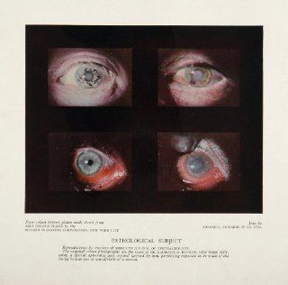1930 Human Eye Pathology Laurence D. Redway Color Print   Original Print  